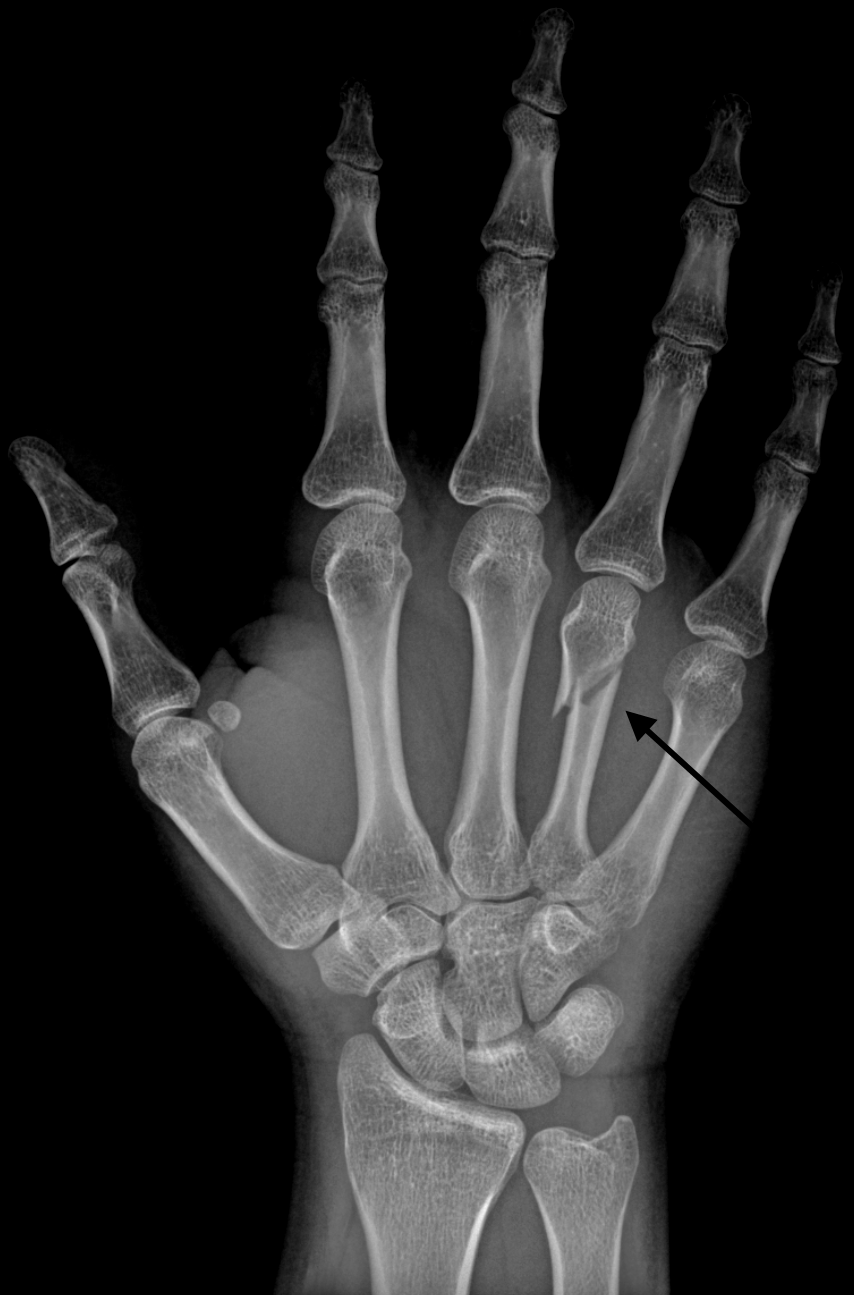 Fracture_hand