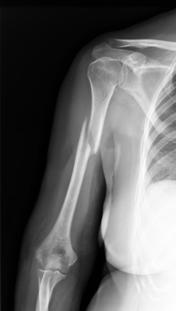 Fracture_arm