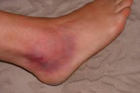 sprain